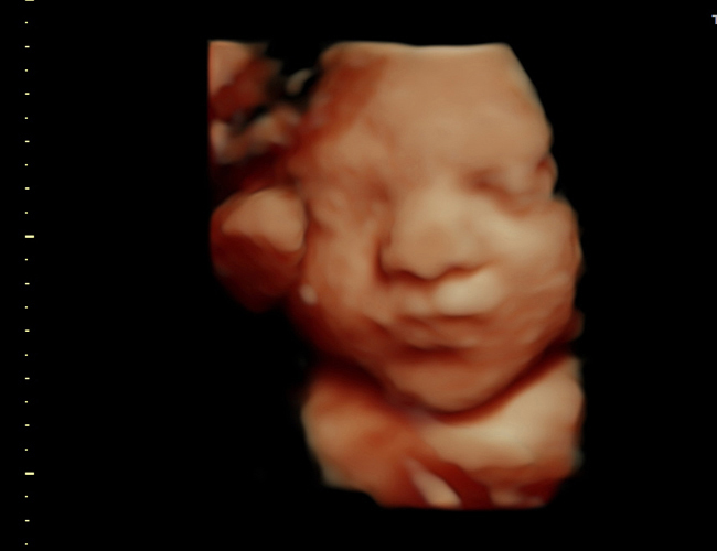 3D ultrasound image at 31 weeks